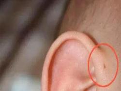 這個小洞一半孩子的耳朵上都有，千萬別亂碰！
